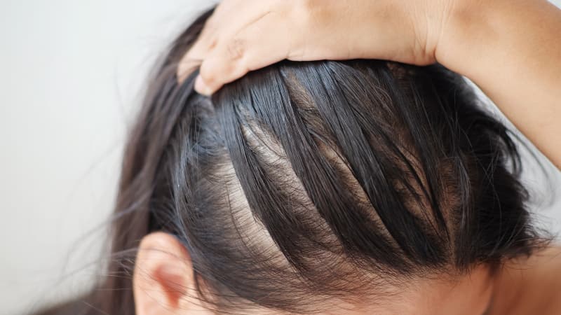 تفاوت بین ریزش مو موقت و دائمی؛ کدام را باید جدی بگیریم؟