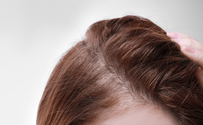 تفاوت بین ریزش مو موقت و دائمی؛ کدام را باید جدی بگیریم؟